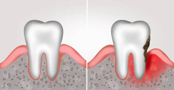 Collage Illustrations Healthy Tooth Gum Diseased Ones Gingivitis Periodontitis — Stockfoto