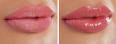 Collage with photos of woman with dry and moisturized lips, closeup. Banner design