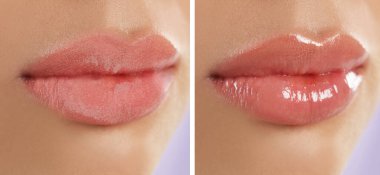 Collage with photos of woman with dry and moisturized lips, closeup. Banner design