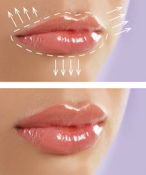 Collage Photos Young Woman Lips Augmentation Procedure Closeup — ストック写真