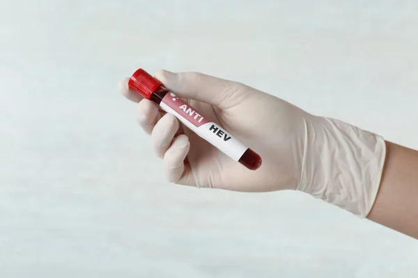 Scientist Holding Tube Blood Sample Label Hev Light Background Closeup — стоковое фото