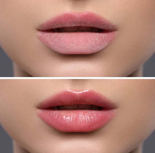 Collage Photos Woman Dry Moisturized Lips Closeup — Foto de Stock