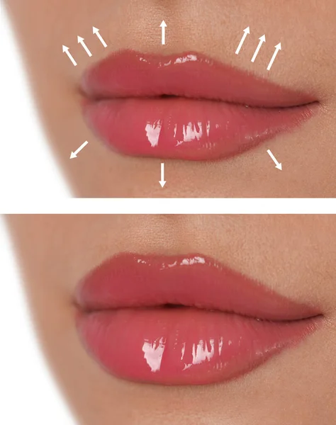 Collage Photos Young Woman Lips Augmentation Procedure Closeup — ストック写真