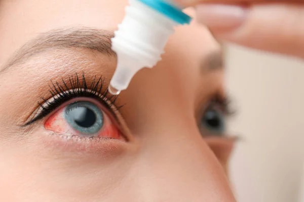 Closeup View Woman Inflamed Eyes Using Drops — Stockfoto