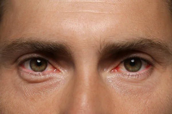 Closeup View Man Inflamed Eyes —  Fotos de Stock