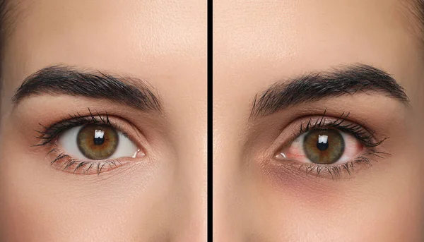 Collage Photos Woman Inflamed Healthy Eyes Treatment Closeup —  Fotos de Stock