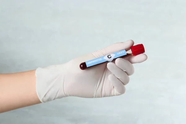 Scientist Holding Tube Blood Sample Label Hepatitis Test Light Background — Stockfoto