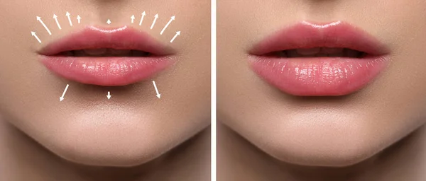 Collage Photos Young Woman Lips Augmentation Procedure Closeup — стоковое фото