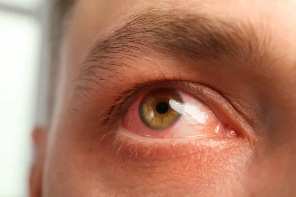 Closeup View Man Inflamed Eyes —  Fotos de Stock