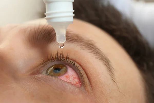 Closeup View Man Inflamed Eyes Using Drops — Foto Stock