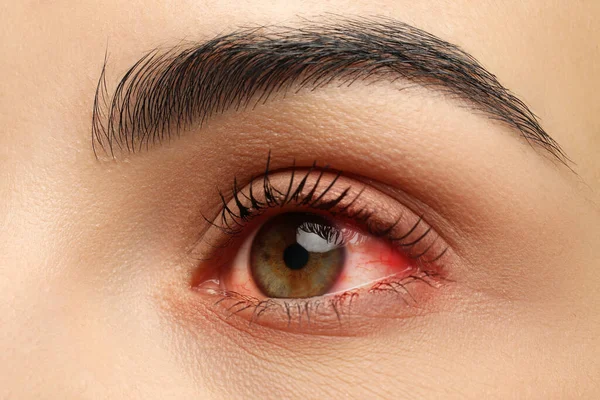 Closeup View Woman Inflamed Eyes — Stock Photo, Image