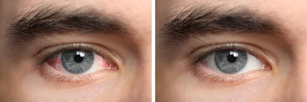 Collage Photos Man Inflamed Healthy Eyes Treatment Closeup Banner Design — Zdjęcie stockowe