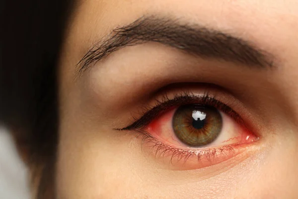 Closeup View Woman Inflamed Eyes — Stock Photo, Image