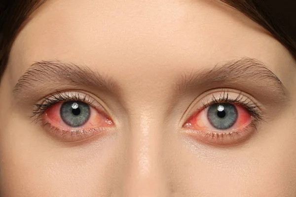 Closeup View Woman Inflamed Eyes — Zdjęcie stockowe