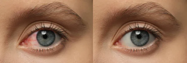 Collage Photos Woman Inflamed Healthy Eyes Treatment Closeup Banner Design — Stok Foto