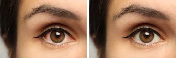 Collage Photos Woman Inflamed Healthy Eyes Treatment Closeup Banner Design — 스톡 사진