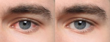 Collage with photos of man with inflamed and healthy eyes before and after treatment, closeup. Banner design