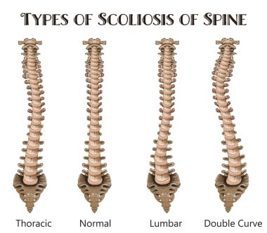 Medical poster demonstrating types of scoliosis on white background. Illustration of healthy and diseased spine