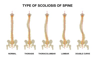 Medical poster demonstrating types of scoliosis on white background. Illustration of healthy and diseased spine