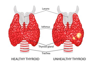 Illustration of healthy and diseased thyroid on white background