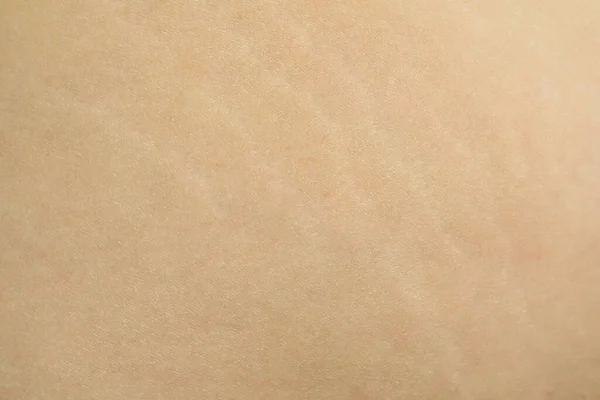 Texture Human Skin Birthmark Stretch Marks Closeup View — Zdjęcie stockowe