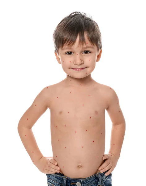 Kleine Jongen Met Waterpokken Witte Achtergrond Varicella Zostervirus — Stockfoto