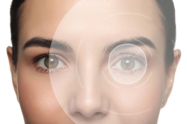 Closeup View Woman Mark Illustration Her Eye Vision Correction Surgery — Stock fotografie