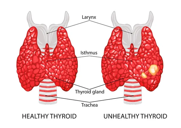 Иллюстрация Здоровой Больной Щитовидной Железы Белом Фоне — стоковое фото