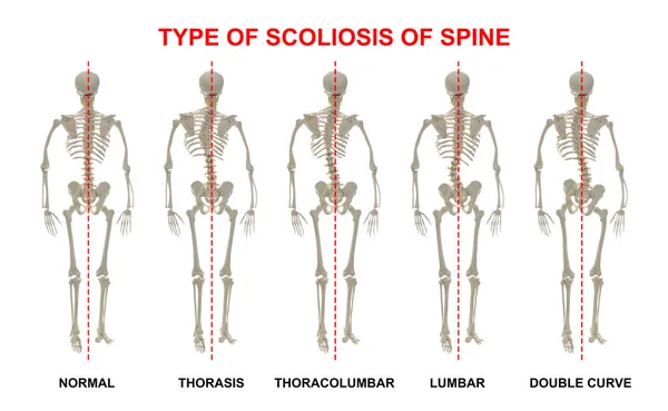 Medical Poster Demonstrating Types Scoliosis White Background Illustration Healthy Diseased — Foto Stock