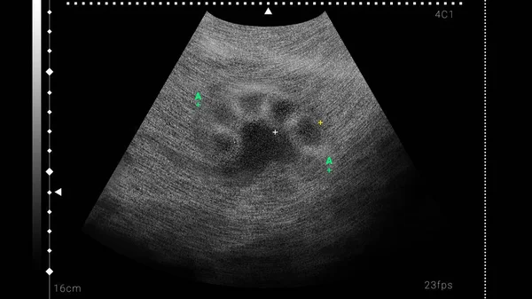 Sonogram Human Kidney Illustration Ultrasound Diagnostic — 图库照片