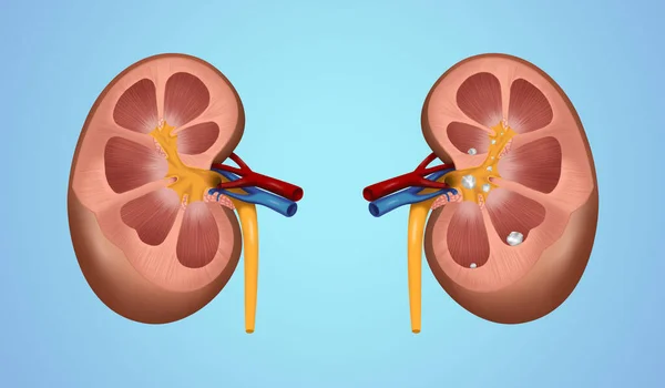 Illustration of human kidney stones on blue background. Banner design