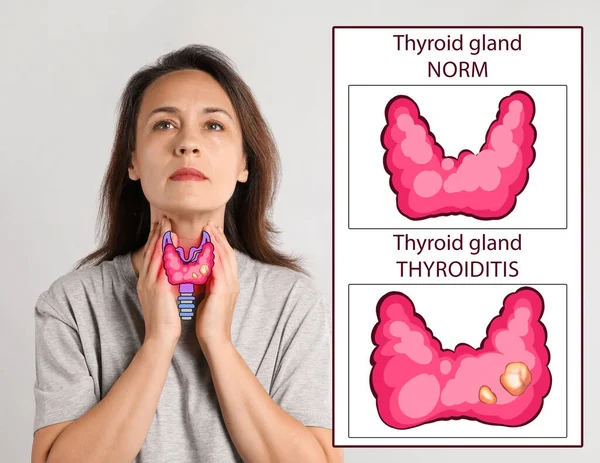 Woman Illustration Thyroid Gland White Background — 图库照片