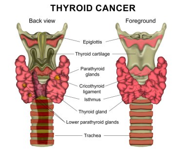 Illustration of human thyroid cancer on white background. Back view and foreground