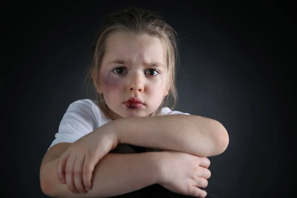 Niña Con Moretones Cara Contra Fondo Oscuro Víctima Violencia Doméstica — Foto de Stock