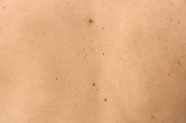 Arka planda doğum lekeleri olan kadın vücuduna yakın çekim