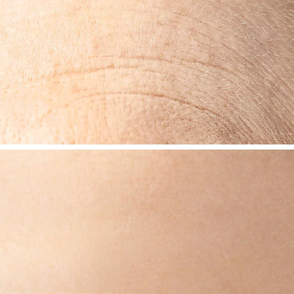 Collage Photos Dry Moisturized Skin Texture — Stock Photo, Image