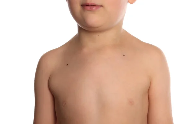 Nahaufnahme Des Körpers Des Jungen Mit Muttermalen Auf Weißem Hintergrund — Stockfoto