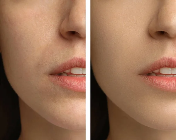 Collage Photos Woman Having Dry Skin Problem Moisturizing Closeup — Stock Photo, Image