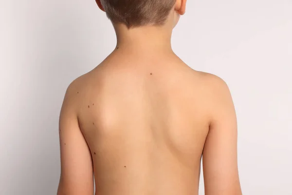 Closeup Boy Body Birthmarks Light Grey Background Back View — Stock Photo, Image