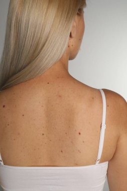 Açık gri arka planda doğum lekeleri olan kadın.