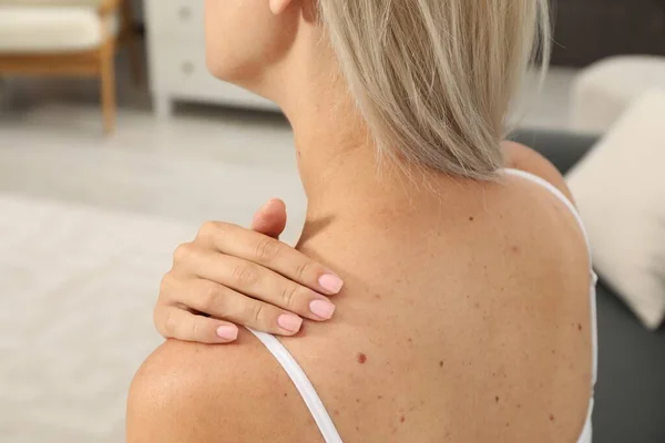 Closeup View Woman Body Birthmarks Indoors — Stock Photo, Image