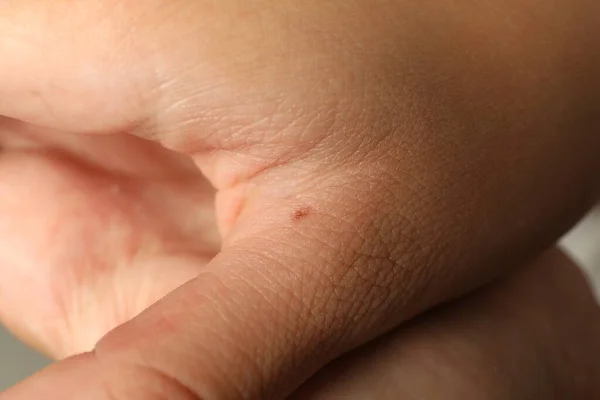 Closeup View Woman Hand Birthmark — Stock Photo, Image