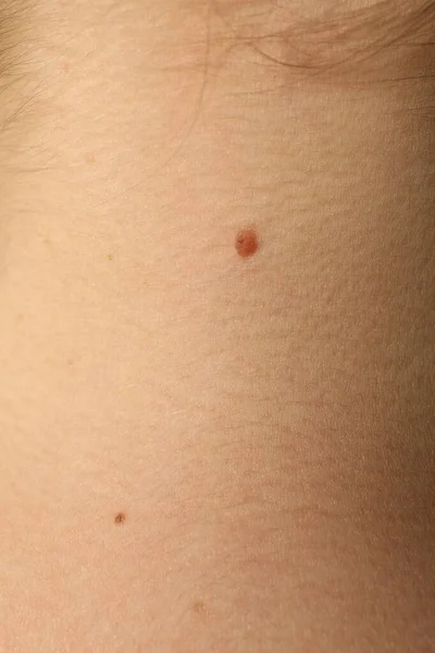 Closeup View Woman Body Birthmarks Background — Zdjęcie stockowe