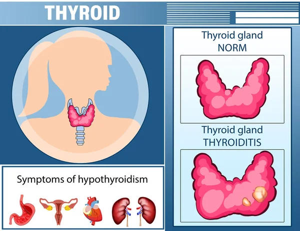 Ilustración Glándula Tiroides Síntomas Hipotiroidismo Cartel Médico — Foto de Stock