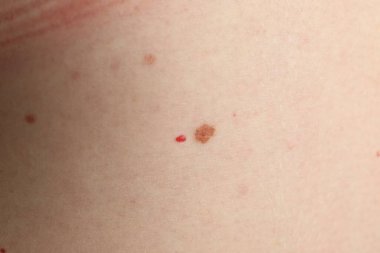 Closeup view of woman's body with birthmarks as background