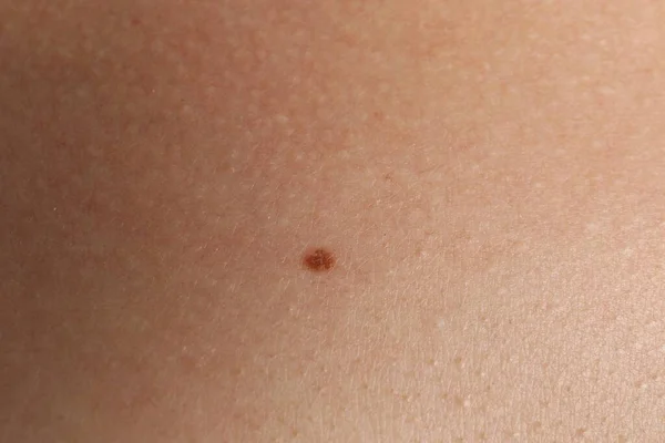 Closeup View Woman Body Birthmark — Zdjęcie stockowe