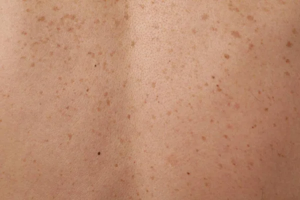 Closeup Man Body Birthmarks Background — Stock Photo, Image
