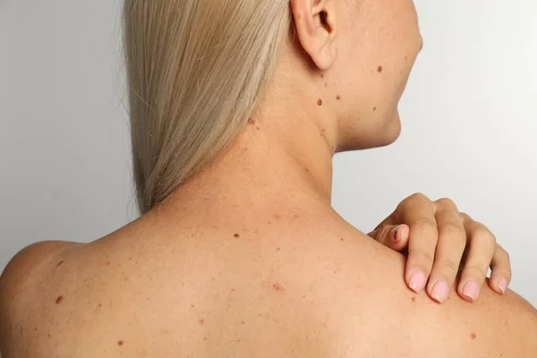 Closeup Woman Body Birthmarks Light Grey Background Back View — Stock Photo, Image