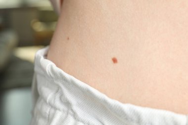 Doğum lekeli kadın vücudunun yakın görüntüsü.