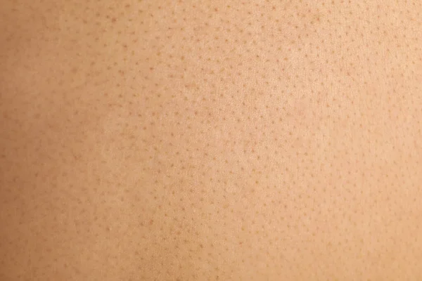 Texture Human Skin Birthmarks Closeup View — Stockfoto